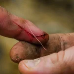 Pulling A Splinter Out Of A Finger